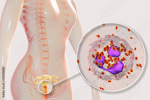 Photography Female gonorrhea, medical concept