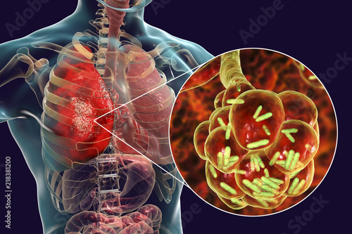 Bacterial pneumonia, medical concept. 3D illustration showing rod-shaped bacteria inside alveoli of the lung