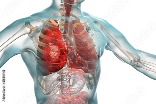 Принти на полотні Pneumonia medical concept, 3D illustration showing lobar pneumonia of the right