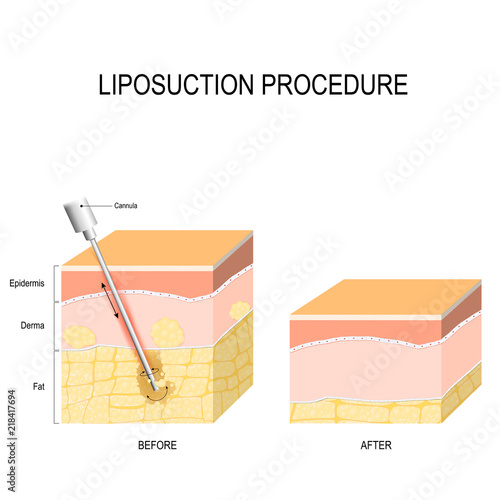 liposuction procedure. Before and after.