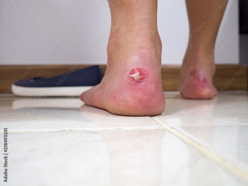 Close up sore hurt pain lesion on foot from shoes pinch because shoes is tight. Close up sore hurt pain lesion on foot from shoes pinch because shoes is tight.