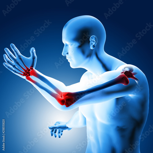 Billede på lærred 3d illustration of a medical figure with painful elbow