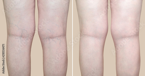 Legs of a woman with varicose veins and capillaries before and after medical treatment