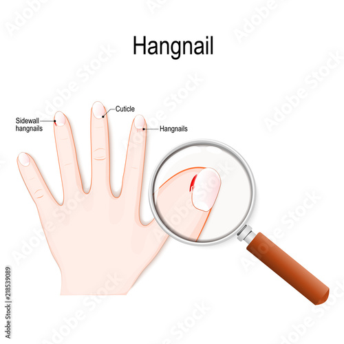 Hangnails