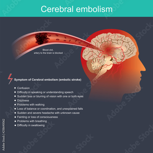 Cerebral embolism. It occurs when a particle from a part of the body travels through the bloodstream to the brain and blocks the blood flow within an artery of the brain.