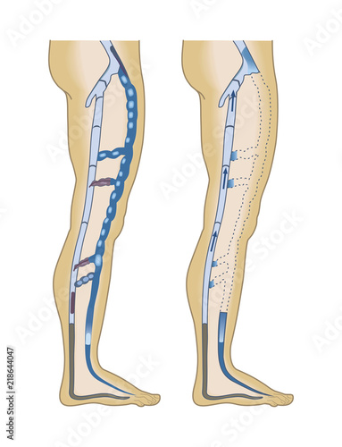 Poster of varicose veins. Medical infographics