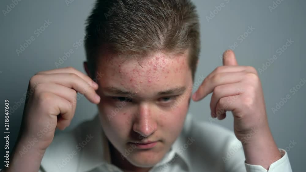 Young man with dermatology acne problems looking at the camera in the studio on the grey background. Young man with dermatology acne problems looking at the camera in the studio on the grey background.