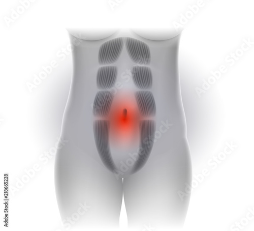 Diastasis Recti also known as Diastasis Rectus Abdominus or abdominal separation, it is common among pregnant women and post birth. There is a gap between the rectus abdominis muscles.