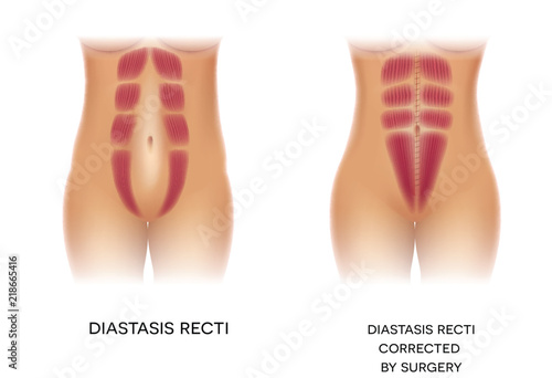 Diastasis Recti also known as Diastasis Rectus Abdominis or abdominal separation, it is common among pregnant women and post birth. Before and after surgery correction. 