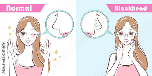 woman with blackhead problem