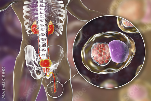 Chlamydiosis infection in man, 3D illustration showing close-up view of Chlamydia trachomatis bacteria infecting urethral epithelial cells, found as chlamydial intracytoplasmic inclusions in a cell photo