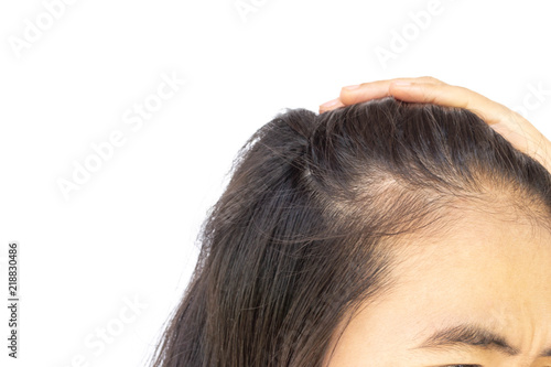 Woman serious hair loss problem for health care