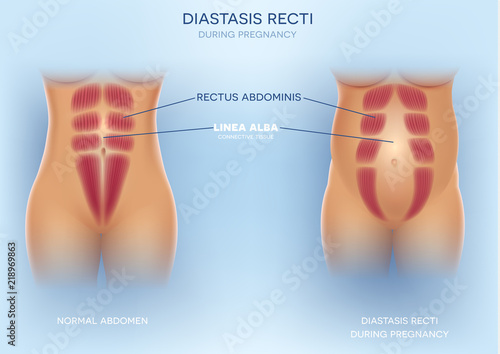 Diastasis Recti during pregnancy, also known as Diastasis Rectus Abdominus or abdominal separation, it is common among pregnant women and post birth. There is a gap between muscles.