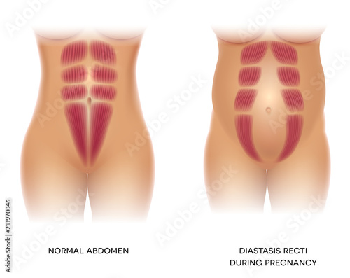 Diastasis Recti during pregnancy, also known as Diastasis Rectus Abdominus or abdominal separation, it is common among pregnant women and post birth. There is a gap between muscles.
