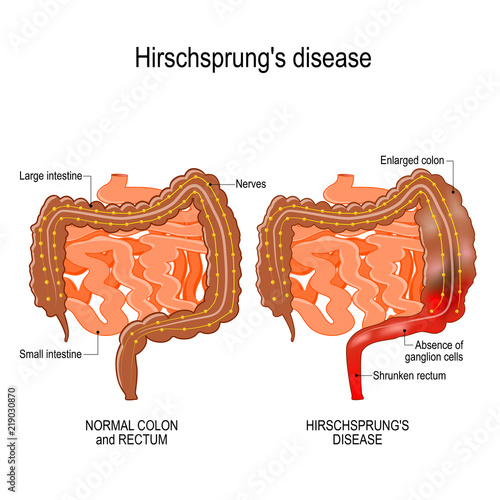 Hirschsprung's disease