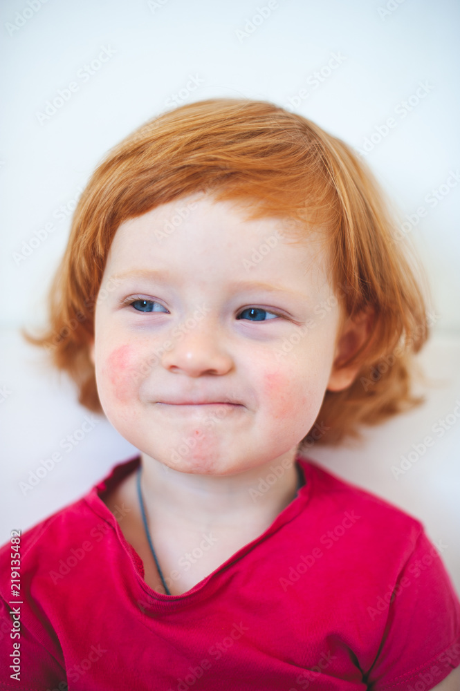 allergies, atopy, atopic dermatitis, dermatitis, ecdysis boy, red-haired, blue-eyed, boy, male, european, curly