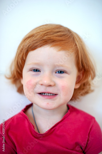 A child with signs of an allergy on the face