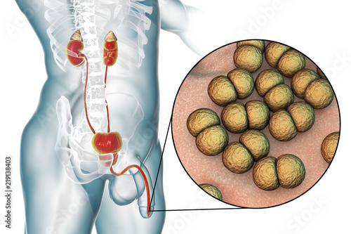 Male gonorrhea, medical concept photo