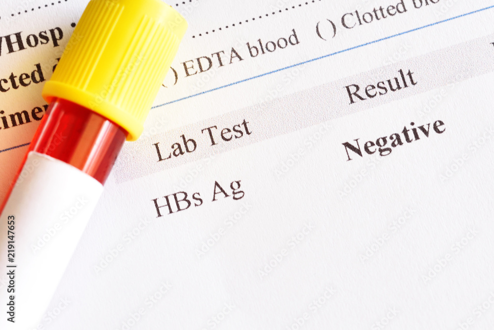 Obraz premium Hepatitis B virus negative test result with blood sample tube