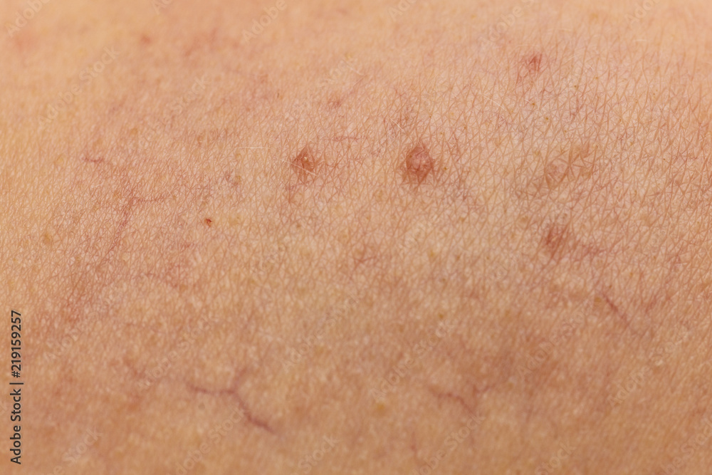 Ski with dilated capillaries ad red spots Ski with dilated capillaries ad red spots