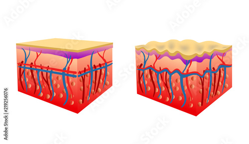 Vector Illustration of two types of skin showing cellulite