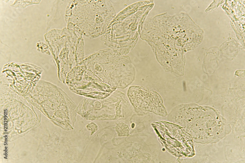 Epithelial cells with bacteria in patient urine (urinary tract infections), analyze by microscope
 photo