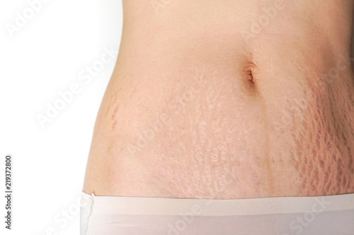 Abdominal scar marked pattern
