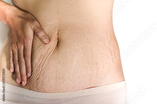Abdominal scar marked pattern