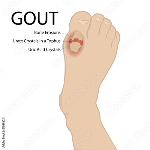 Gout arthritis. Human foot. Vector medical illustration.