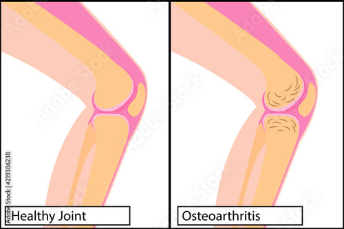 Healthy knee joint and osteoarthritis medical vector illustration 