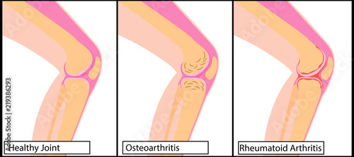 Types of arthritis  Knee medical vector illustration 
