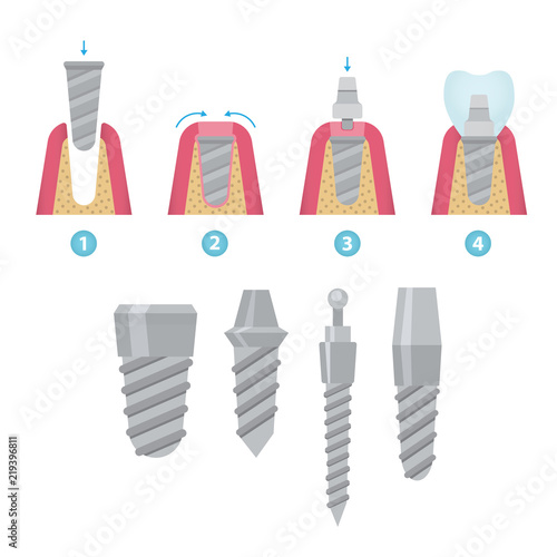 Dental crowns and implantation