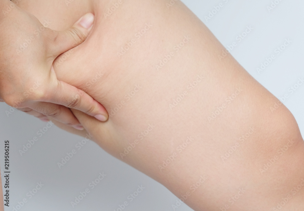 Female legs thighs with cellulite. Skin problem, body care, overweight and dieting concept, diabetic risk factor. Female legs thighs with cellulite. Skin problem, body care, overweight and dieting concept, diabetic risk factor.