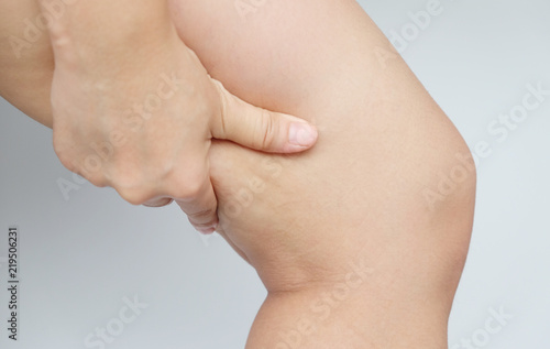Female legs thighs with cellulite. Skin problem, body care, overweight and dieting concept, diabetic risk factor.