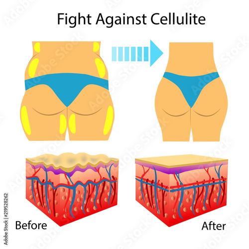 Vector Illustration of two types of skin showing cellulite, isolated