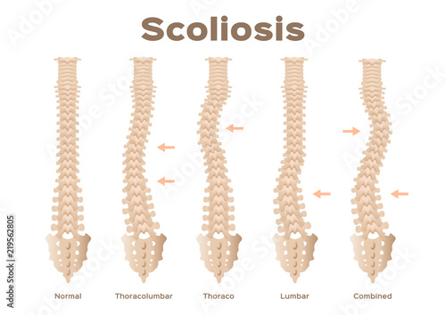 type, scoliosis medical anatomical vector / backbone / organ photo