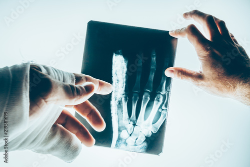Doctor surgeon or traumatologist and patient are studying X-ray picture of a fractured hand on the lumen photo