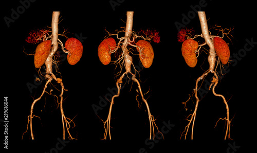Фотография CTA ABDOMINAL AORTA AND FEMORAL RUN OFF  FINDINGS:  infrarenal aortic aneurysm with partial thrombosis 3D rendering