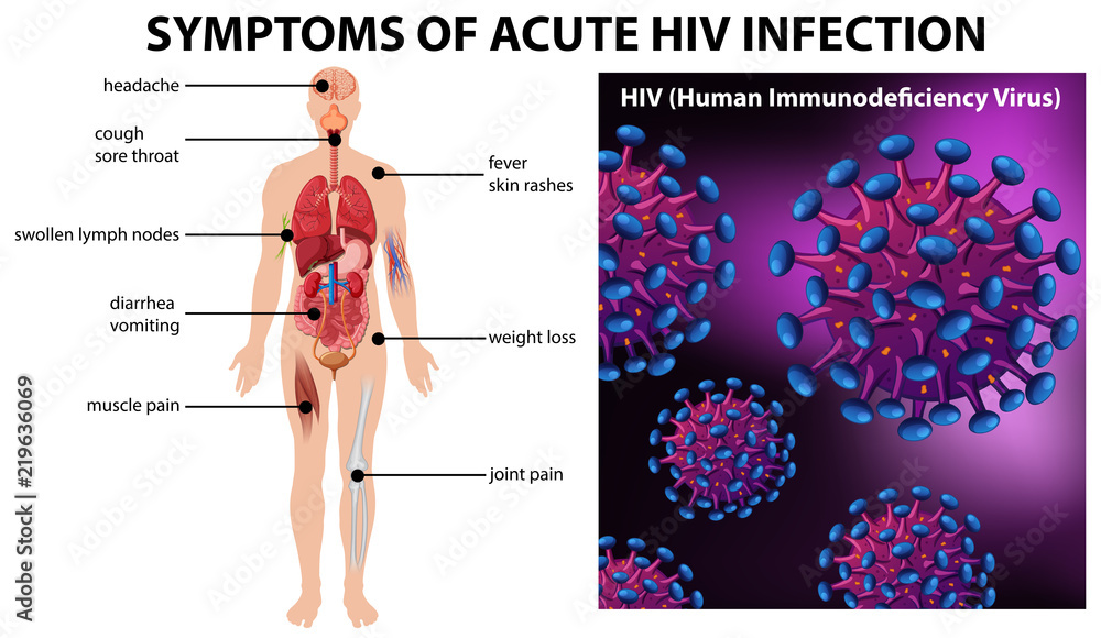 Symptoms of acute HIV infection - obrazy, fototapety, plakaty 