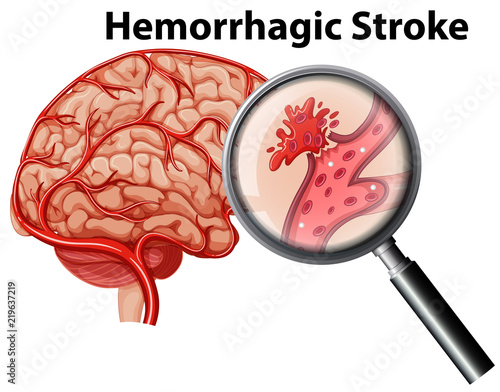 A human anatomy hemorrhagic stroke photo