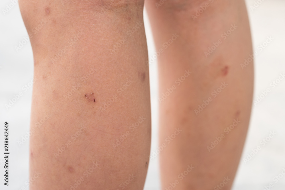 .Selective focus on dried skin legs of Asia kid child with lesions rash as sick from eczema disease or allergy from mosquito bites.Healthcare concept. .Selective focus on dried skin legs of Asia kid child with lesions rash as sick from eczema disease or allergy from mosquito bites.Healthcare concept.