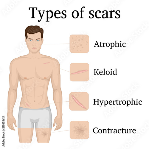 Illustration of the types of scars