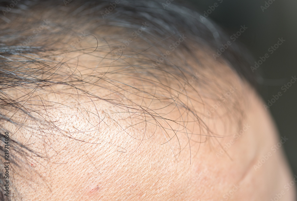 A middle-aged man with hair loss. Baldness A middle-aged man with hair loss. Baldness