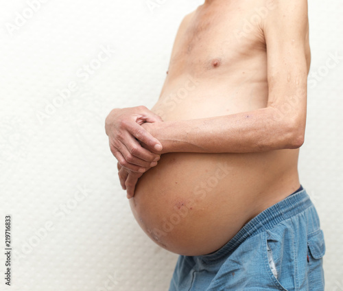 ascitic disease in man