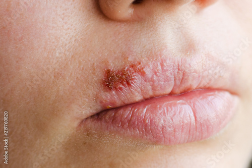 Part of a young woman's face with a virus herpes on lips photo