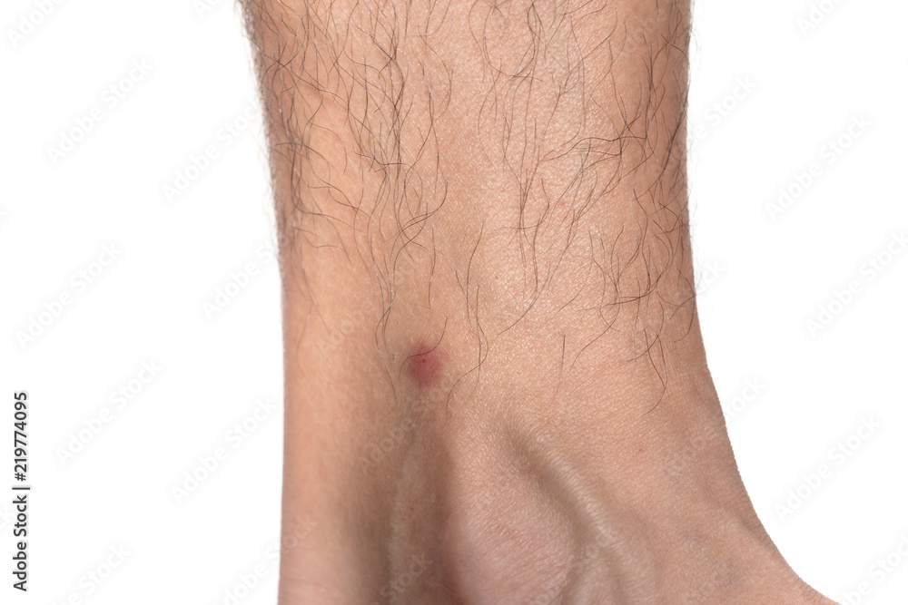 Obraz premium red dot on skin from bite bugs