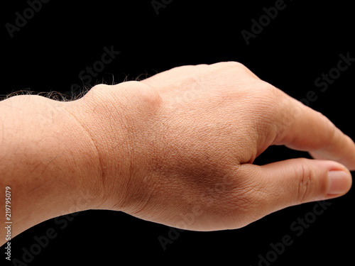 Fotografie carpal ganglion cyst in wrist on black blackground
