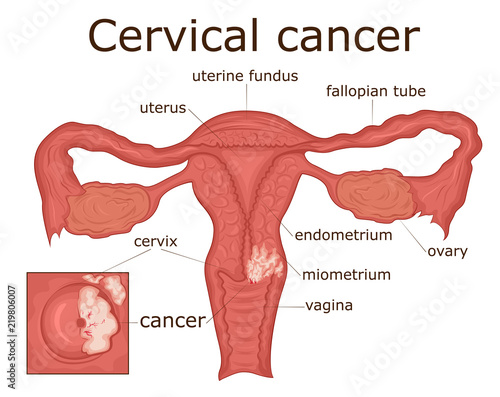 Illustration of cervical cancer photo