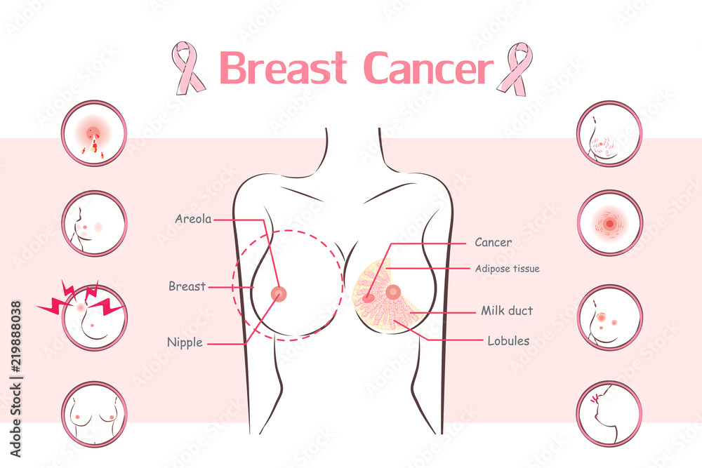 woman with breast cancer symptom woman with breast cancer symptom