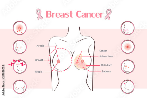 woman with breast cancer symptom